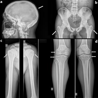 Misdiagnosis of Paget’s Disease of Bone in a Congenital Generalized Lipodystrophy Patient: Case Report